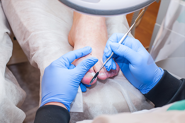 An image of a chiropodist using a tool on someones foot